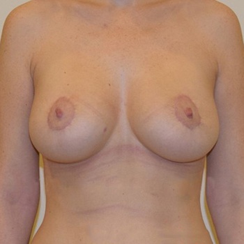 Пациентке была произведена подтяжка груди (мастопексия).